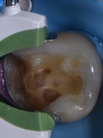 REPORTAŻ KLINICZNY. Złożona odbudowa kompozytowa