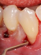 Pokrycie mnogich recesji dziąsłowych całego łuku zębowego na jednej wizycie (...)