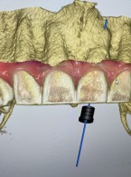 REPORTAŻ KLINICZNY. Leczenie zęba siecznego z obliteracją kanału (...)