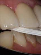 Wstęp do procesu planowania leczenia u pacjentów z brakami tkanek twardych (...)