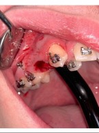 Zastosowania biostymulacji laserowej do przyspieszenia leczenia ortodontycznego
