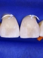 REPORTAŻ KLINICZNY. Odbudowa zęba przedniego materiałem kompozytowym (...)