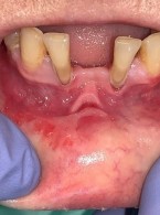 Oral mucositis w przebiegu terapii metotreksatem (...)