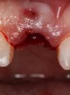 Horyzontalne złamanie korzenia zęba siecznego przyśrodkowego (...)