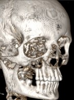 Rak nabłonkowo‑mioepitelialny małych gruczołów ślinowych. Opis przypadku