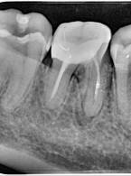 Hemisekcja jako przykład zabiegu z zakresu chirurgii endodontycznej (...)