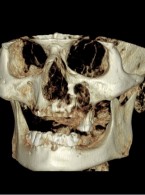 Leczenie rozległej zakażonej torbieli szczęki (...)