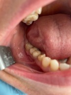 Leczenie periimplantitis przy użyciu lasera erbowo‑yagowego (...)