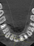 Resorpcja wewnętrzna zęba siecznego przyśrodkowego w dwóch odsłonach (...)