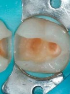 Wypełnienia w odcinku bocznym z użyciem Admira Fusion