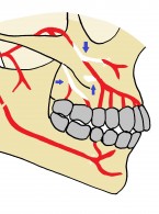 Zespół Nicolau po leczeniu endodontycznym – opis przypadku