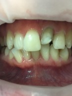 Odroczone zaopatrzenie protetyczne zęba po zwichnięciu (...)