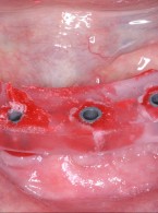 Protetyczne możliwości rekonstrukcyjne u pacjentów bezzębnych