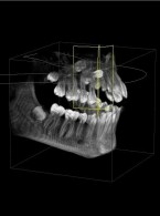 Torbiel zawiązkowa – własne przypadki kliniczne