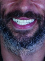 REPORTAŻ KLINICZNY. Estetyczna przebudowa uzębienia u pacjenta z bruksizmem (...)