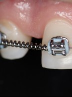 Tymczasowa odbudowa bocznego zęba siecznego szczęki (...)