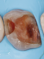 Nakład bezpośredni – kompozytowa odbudowa bezpośrednia z przykryciem guzków (...)