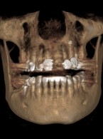 Zastosowanie badania CBCT w leczeniu endodontycznym