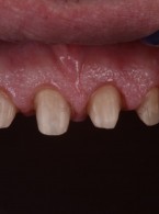 Przebudowa estetyczna z wykorzystaniem wydłużenia koron (...)