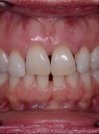 Miejscowa antybiotykoterapia w leczeniu zapaleń przyzębia – opis przypadku