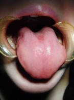 Obraz zmian w jamie ustnej w przebiegu COVID-19 (...)