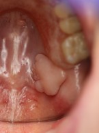 Włókniak urazowy błony śluzowej podniebienia (...)