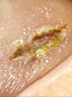 Zastosowanie wielofalowego lasera diodowego do usunięcia tłuszczaka