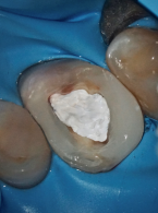 Część 2. Zamykanie i zabezpieczanie dostępu endodontycznego 