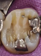Bezpośrednie, złożone wzmocnienie zębiny okołoszyjkowej zęba leczonego endodontycznie (...)