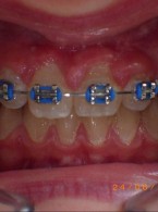 Zatrzymany ząb sieczny szczęki. Opis przypadku