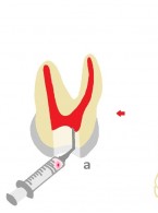 Zastosowanie biodruku 3D w stomatologii (...)