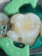 Leczenie odtwórcze próchnicy na powierzchni stycznej zęba 16 (...)