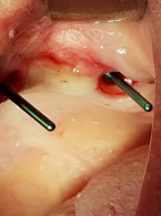 Ultrakrótkie implanty jako skuteczna alternatywa w sytuacji (...)