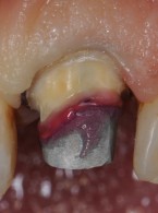 REPORTAŻ KLINICZNY. Korona tymczasowa jako rozwiązanie (...)