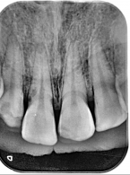 Pourazowa resorpcja zewnętrzna przyszyjkowa – opis przypadku