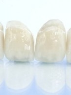 Uszkodzenia ceramiki licującej uzupełnień na podbudowie z tlenku cyrkonu (...)