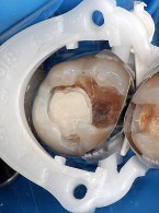 Bezpośrednia odbudowa kilku zębów z użyciem materiału kompozytowego (...)