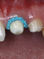 Wykonanie wycisku przedniego zęba szczęki z wykorzystaniem pasty retrakcyjnej