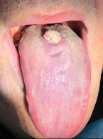 Leczenie brodawczaka płaskonabłonkowego błony śluzowej języka (...)