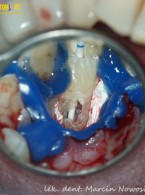 Leczenie zęba siecznego szczęki z resorpcją przyszyjkową i zapaleniem tkanek (...)