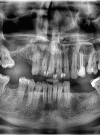 Leczenie zainfekowanej torbieli zęba 24 (...)
