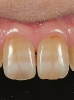 Odbudowa mikrodontycznych zębów siecznych bocznych szczęki (...)