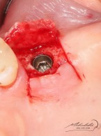 Podniesienie dna zatoki szczękowej metodą otwartą (...)