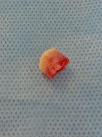 Technika pierścieni kostnych