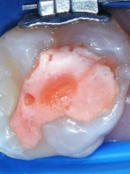 Nadwrażliwość pozabiegowa po wykonaniu wypełnienia kompozytowego (...)