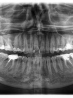 Ponowne leczenie endodontyczne – leczenie ze zmiennym scenariuszem (...)