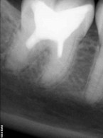 Apeksyfikacja zęba trzonowego żuchwy z użyciem Biodentine