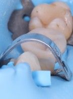 Nakład kompozytowy bezpośredni jako jedna z alternatyw (...)