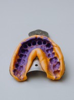 Zastosowanie różnych technik wyciskowych w implantoprotetyce (...)