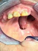 Rehabilitacja protetyczna pacjentów onkologicznych